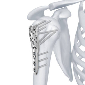 Trama Locking System